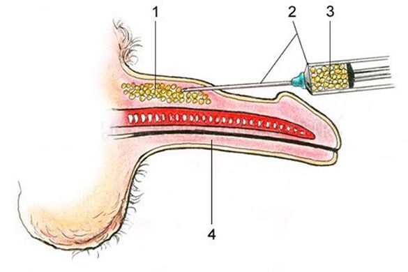 Lipofilling - zsírszövet bejuttatása a pénisz szárába