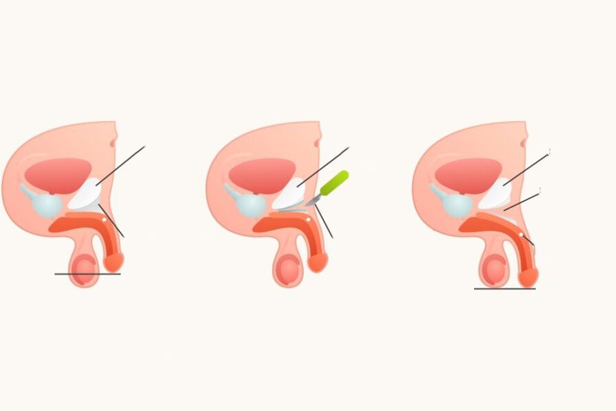 Ligamentotomia a pénisz növelése érdekében