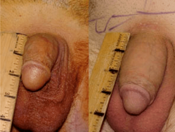 Lipofilling és gélbeültetés előtt és után