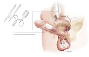 implantátumok behelyezése a péniszbe